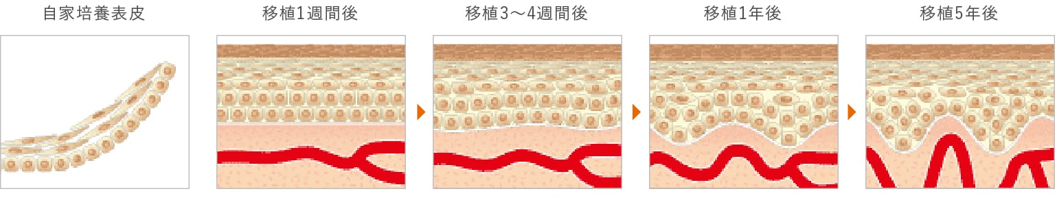 図：自家培養表皮の移植後の経過