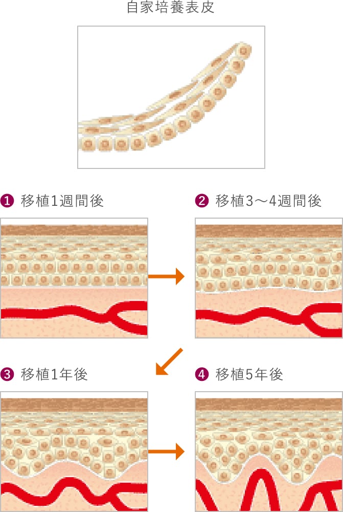 自家培養表皮ジェイス 株式会社ジャパン ティッシュ エンジニアリング J Tec
